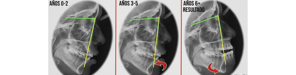 evolucion-cefalometrica-del-crecimiento-facial-en-ortopedia-dentofacial