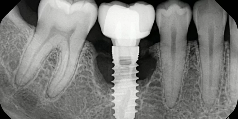 Radiografía periapical digital de alta definición