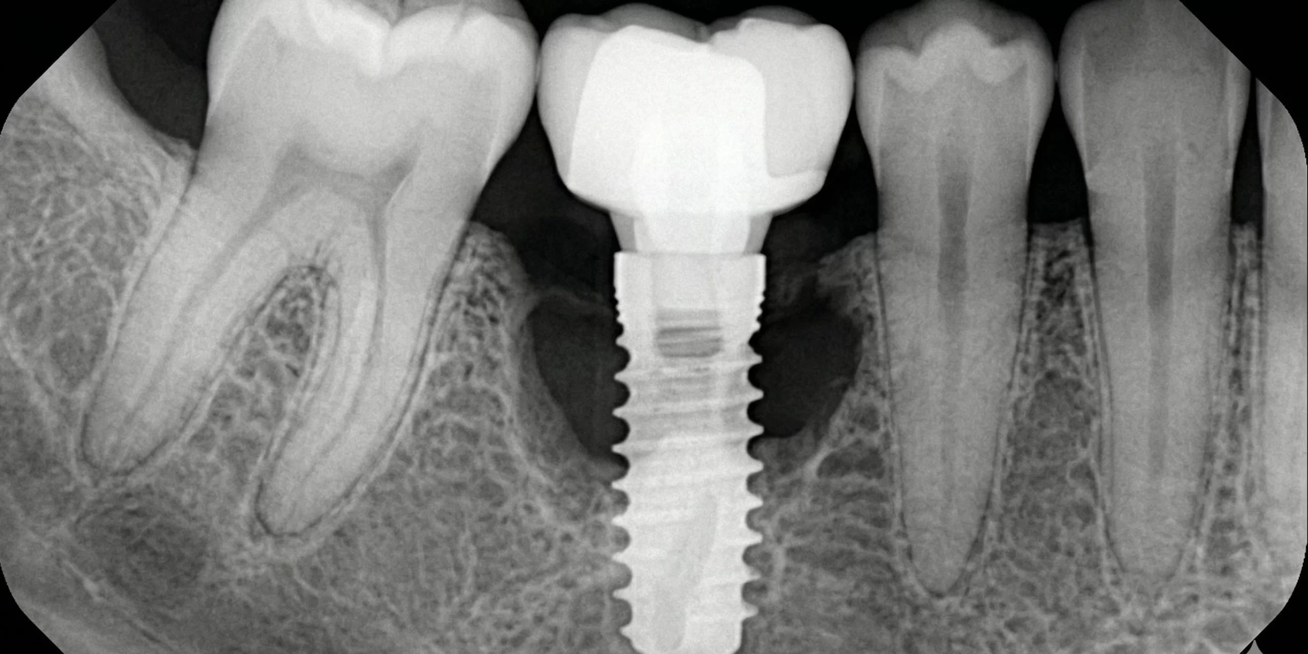 Radiografía periapical digital de alta definición