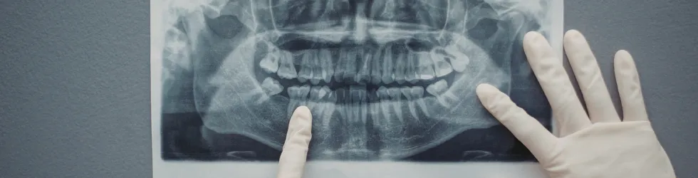 Mano de doctor señala en una radiografía dental