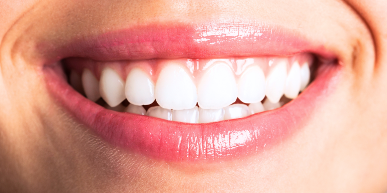 Sonrisa femenina con carillas dentales