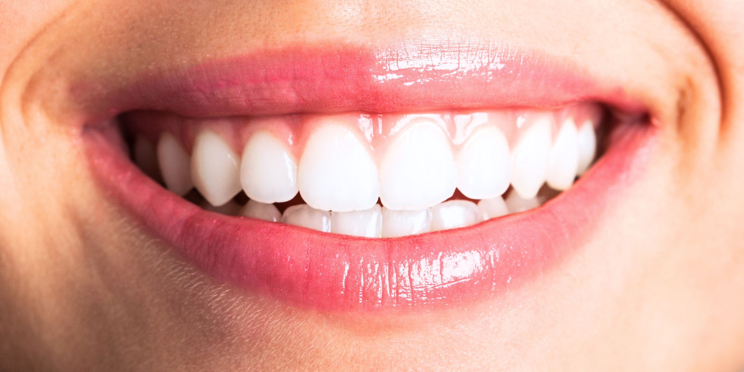 Sonrisa femenina con carillas dentales